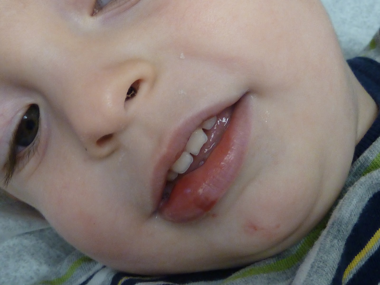 The Vandervort Family Blog Busted Lip. No joke.