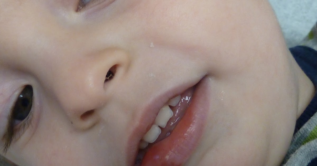 The Vandervort Family Blog Busted Lip. No joke.