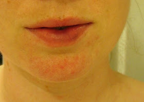 How to get rid of a bruised lip from kissing