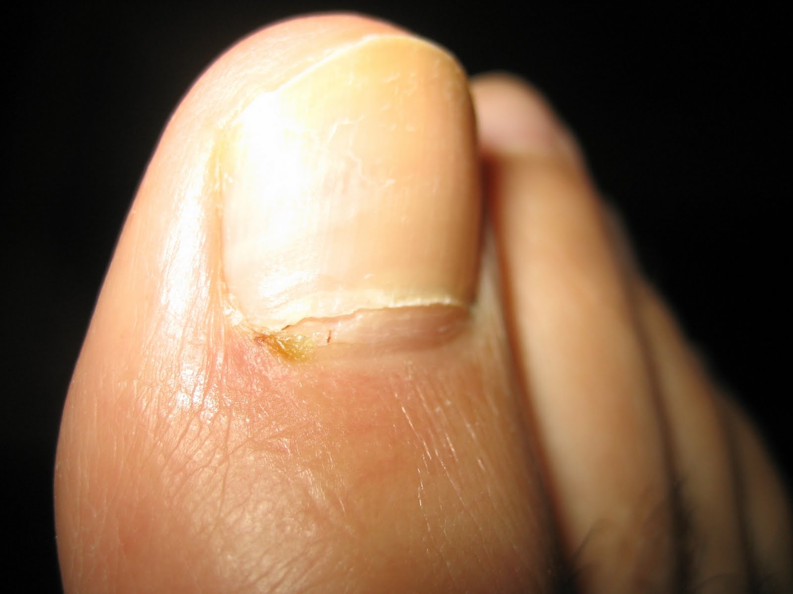 Hammer Toe