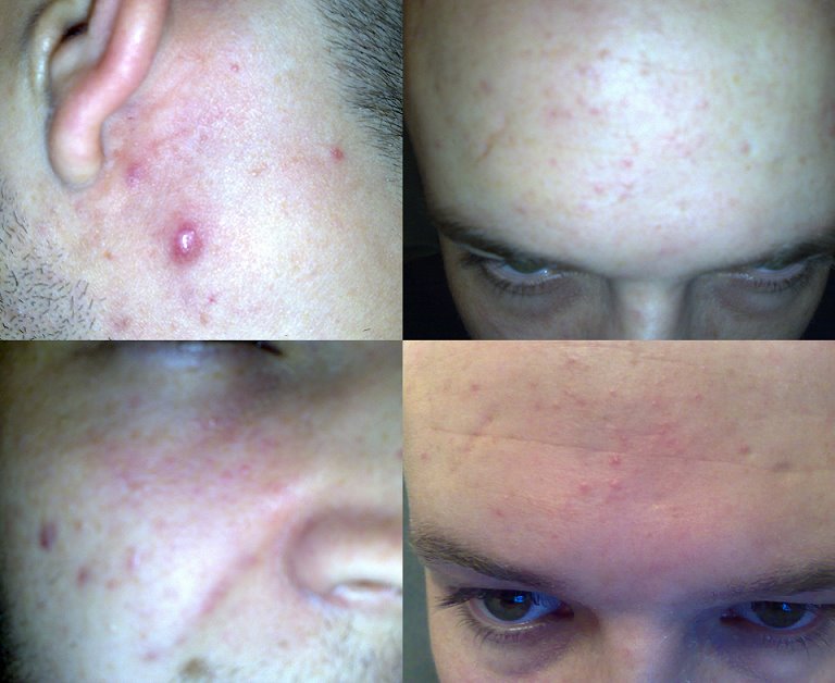 Pictures of  me taken in Sept 2008 - before my microderm and me using Agera Rx products