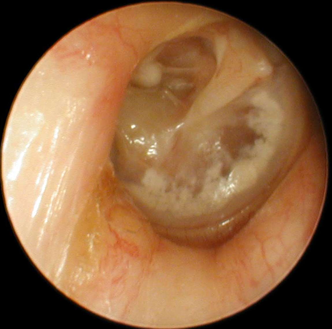 ear tubes discharge