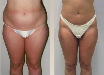 Laser Lipo Lipoescultura Liposuccion Liposuction Tumescent Liposuction Clinic Arroyo Goldstein Lima Peru
