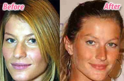 celebrity plastic surgery celebrity plastic surgery