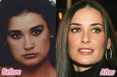 celebrity plastic surgery celebrity plastic surgery