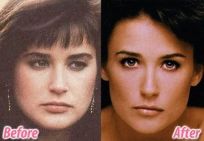 celebrity plastic surgery celebrity plastic surgery