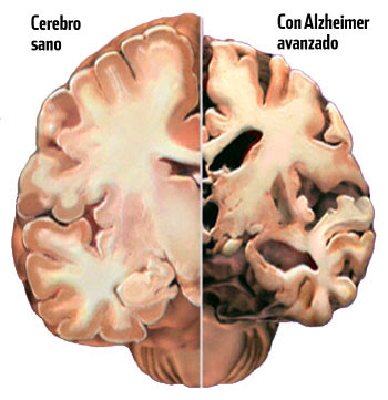 http://2.bp.blogspot.com/_b0g8TMHvNzE/SV3y2SxxLXI/AAAAAAAAABM/-UZmOy8Yr9Y/s400/cerebro+afectado+por+el+Alzheimer.jpg