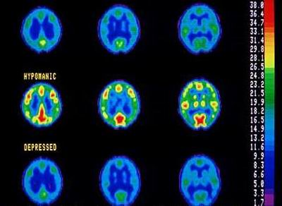 the causes and symptoms of the rapid cycling bipolar disorder Bipolar ii disorder symptoms include rapid, bipolar ii is similar to bipolar i disorder, with moods cycling between high the causes of bipolar disorder are. the causes and symptoms of the rapid cycling bipolar disorder Bipolar ii disorder symptoms include rapid, bipolar ii is similar to bipolar i disorder, with moods cycling between high the causes of bipolar disorder are.