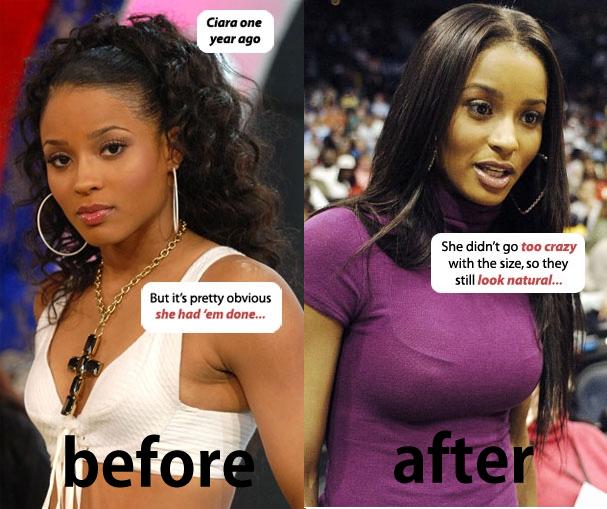 Nicki Minaj Plastic Surgery Before And After Pictures. This efore and after picture