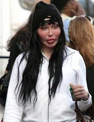 Botched Plastic Surgery on Pete Burns Botched Plastic Surgery Face   Cosmetic Plastic Surgery