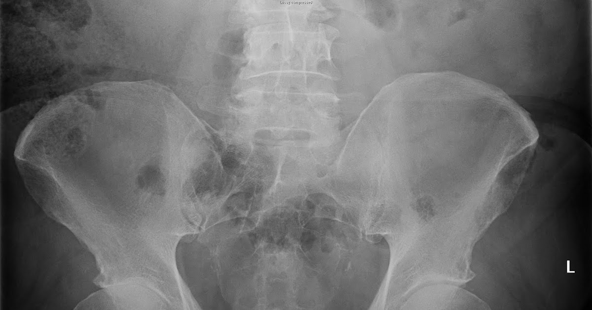 Daily Dose Pistol grip deformity