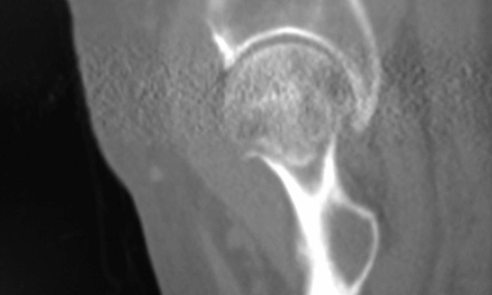 fractured neck of femur symptoms