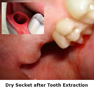 What Is A Dry Socket After A Tooth Is Extracted