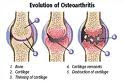      osteoarhritis.jpg