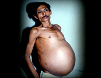 Fetus In Fetu<br />