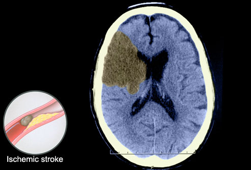 Ct+scan+brain+stroke