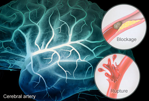 Blood vessel tangles in brain best left alone