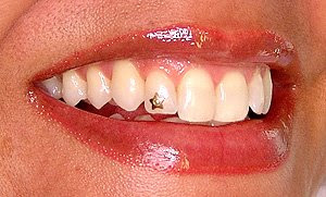 piercing estrela no dente