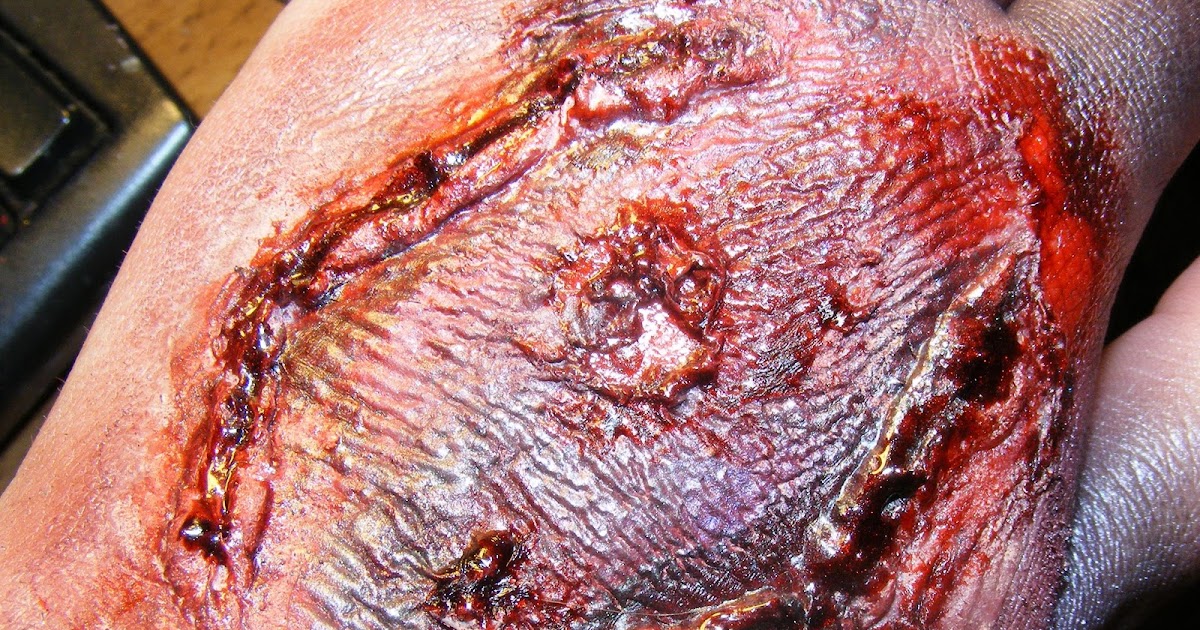 infected tick bite infected tick bite