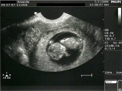 Polycystic ovarian syndrome or PCOS is probably one of the most common ... Polycystic ovarian syndrome or PCOS is probably one of the most common ...