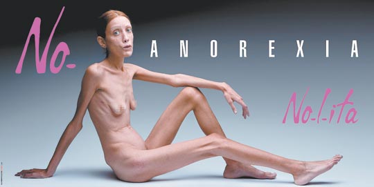 anorexic person in world. anorexic person in world.