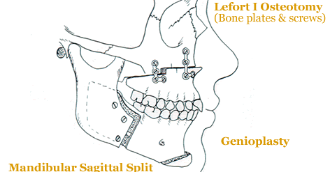 Jaw Dropping Experience: Post-op orthodontic appointment #1