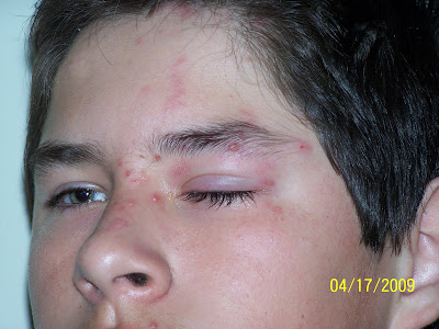 Shingles+Behind+Ear Shingles Behind Ear http://deborahs-journey.blogspot.com/2009/04 ...