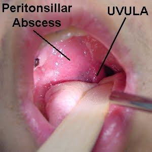 Tonsil Rupture