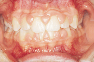 Gingival Hyperplasia Phenytoin