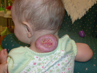 Piper's Strawberry Scoop - hemangioma diary