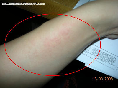 pictures of heat rash on babies. lah still got heat rash?