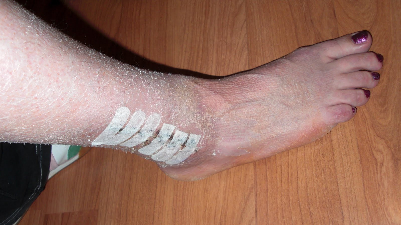 Diary of My Broken Ankle Hell