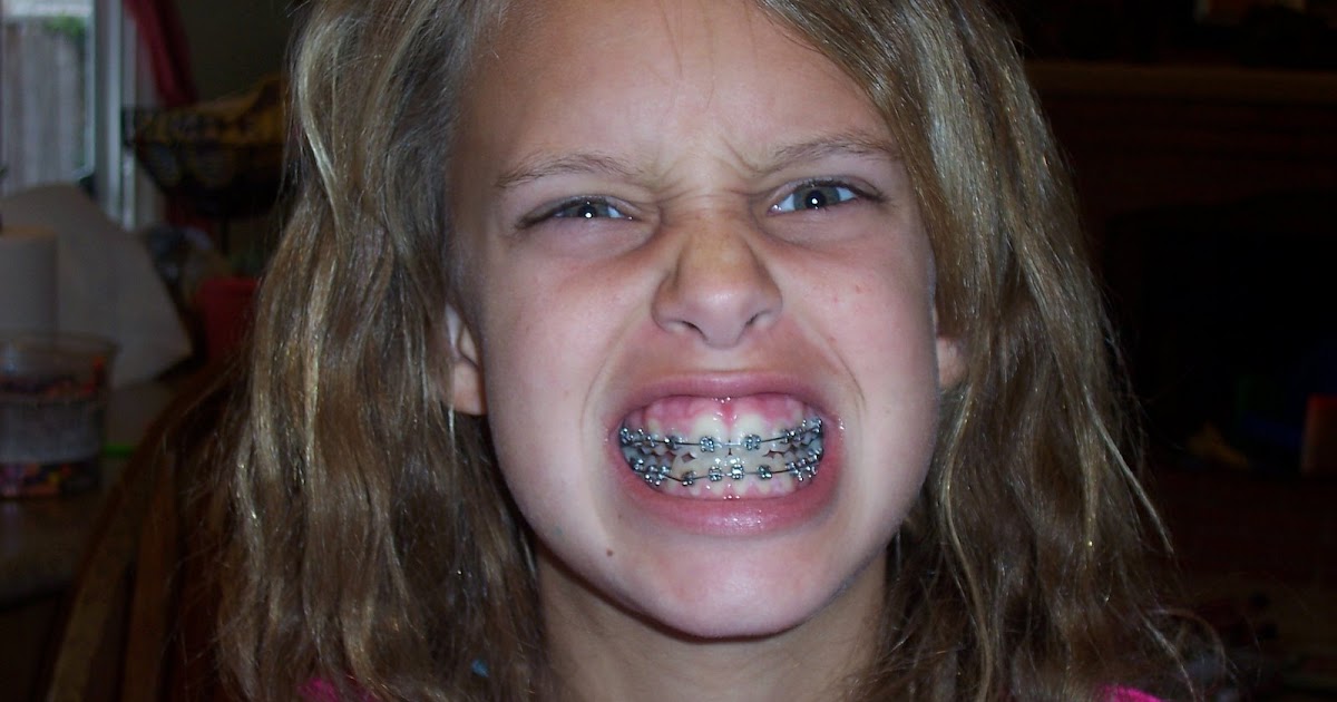 Emily Gatchell I NOW HAVE BRACES!!!