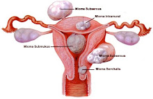 Macam-macam Jenis Mioma Uteri