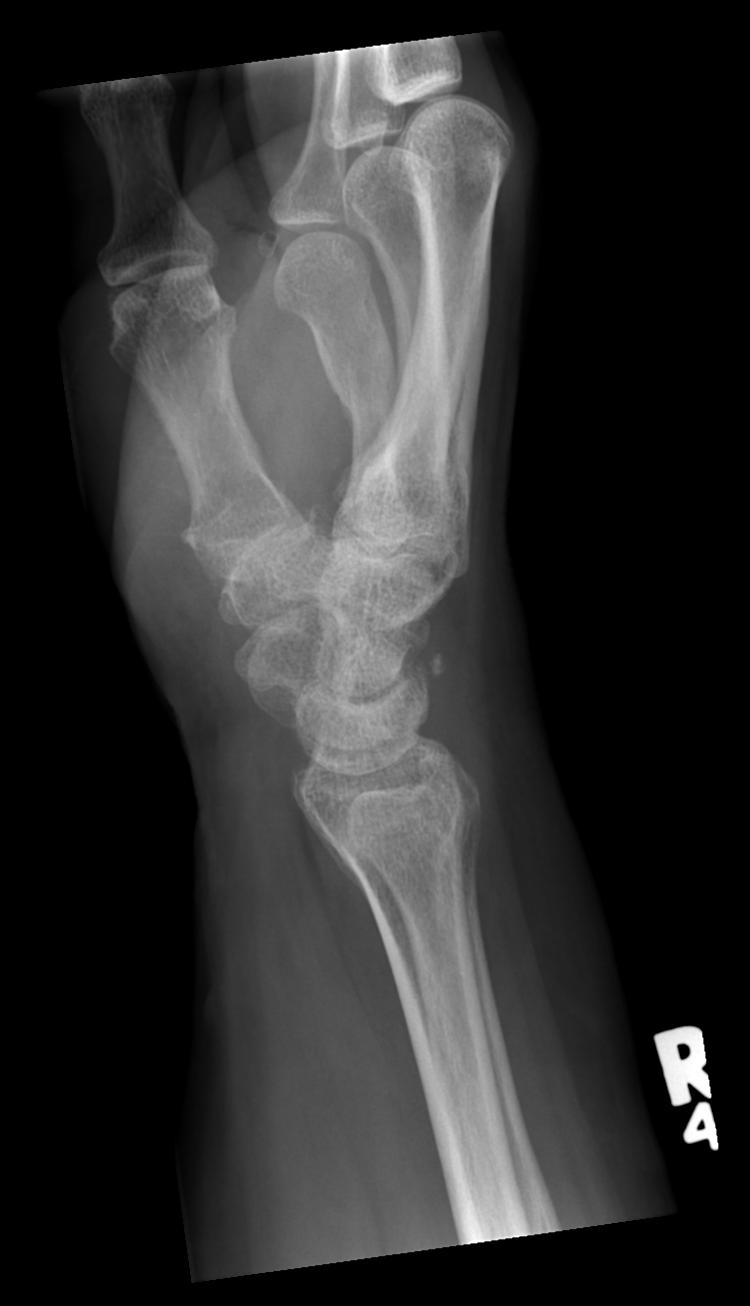 avulsion fracture