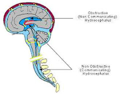 Hydrocephalus