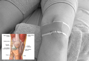 Genoll lesionat