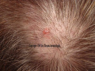 Scalp Warts