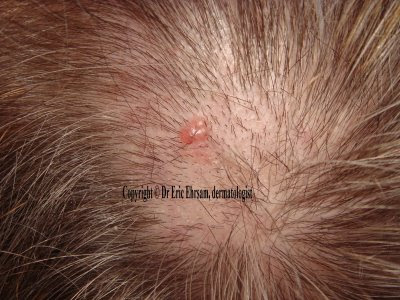 Basal Cell Carcinoma Pictures Scalp