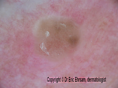 subcorneal hemorrhage