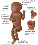 trisomy a Trisomy Wellness com Your guide to the best of health and