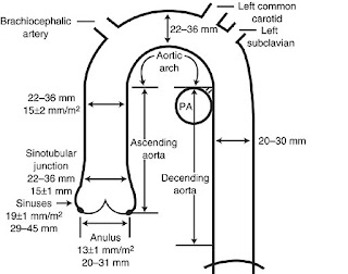 Aortic Root Size Chart