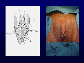 pic operasi gantikelamin dari wanita menjadi pria Operasi+dari+Wanita+Menjadi+Pria+1