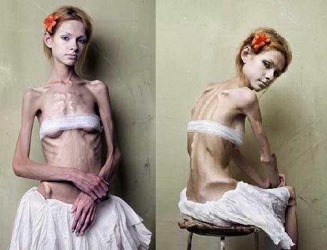 Anorexia