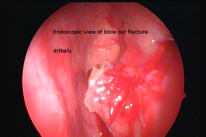 Fracture Management-2.bp.blogspot.com Blow Out Fracture