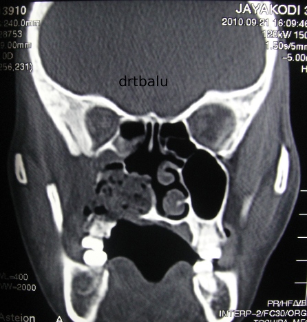 Ct+scan+sinus+polyps