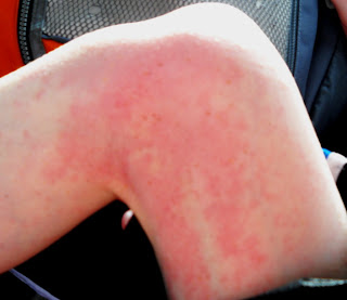 Cold Urticaria Children