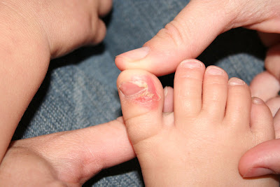 cellulitis of toe