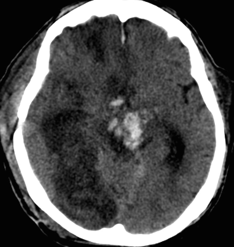 duret haemorrhage