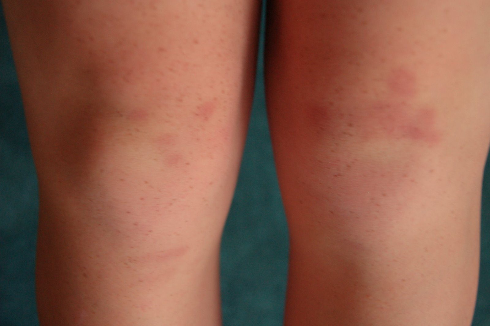 [bruised+knees.jpg]
